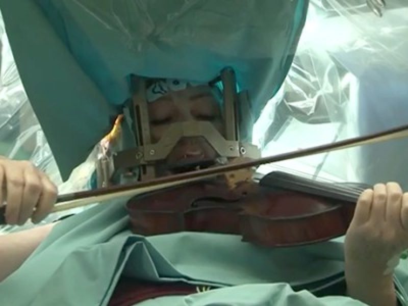 La violinista suona mentre è operata al cervello L’incredibile storia